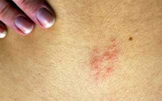 Герпес на спине болит все