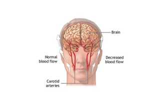 Меняется погода голова болит