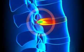 От чего болит спина в области лопаток и шеи