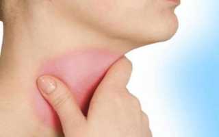 Слабость болит голова т горло но температуры нет что это может быть