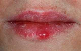 Когда кашлю голова сильно болит что делать