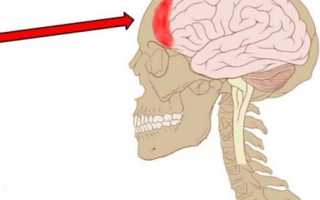 Если болит лобная часть головы что это может быть