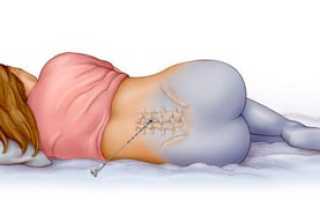 Долго болит спина после эпидуральной анестезии