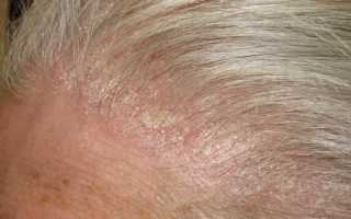 На голове появилась болячка и болит