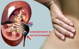 Болит левая сторона спины месяц