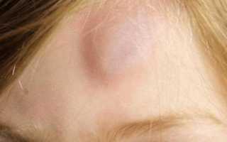 На голове появилась шишка очень болит