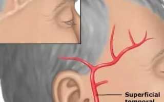 Болит голова в виске правом