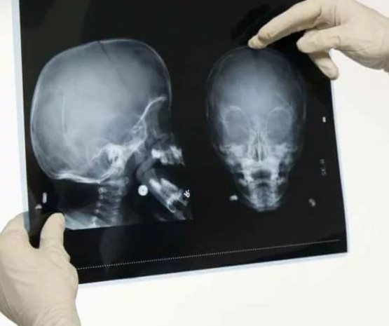 при насморке болит голова в области лба