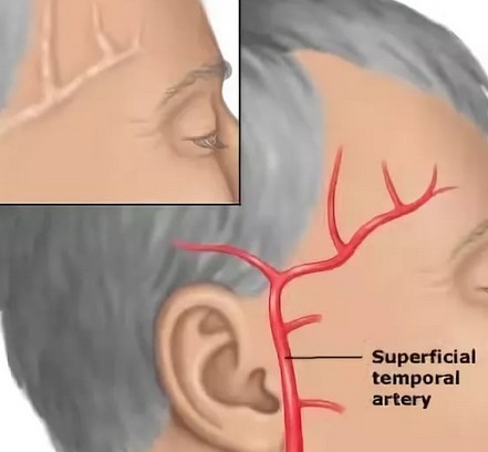Болит голова в виске правом