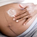 Как избежать растяжек во время беременности