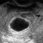 Отслойка плодного яйца при беременности