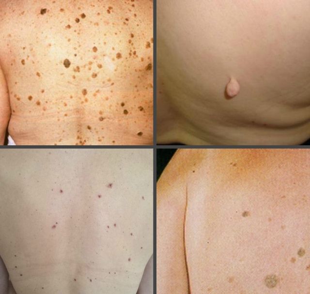 Как выглядит бородавка на спине