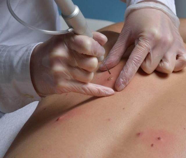 Удаление бородавок на спине