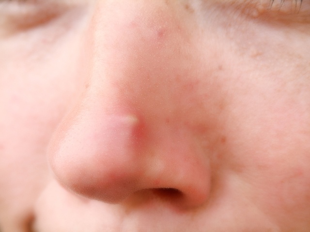 Почему болит при заложенном носе голова и что это может быть