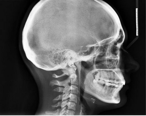 Болит голова после вставания