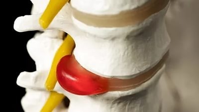 Сильно болит спина в области поясницы при ходьбе