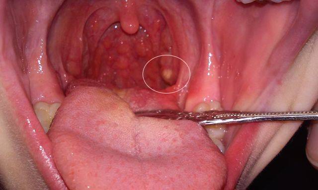Гнойники в горле у взрослого чем лечить
