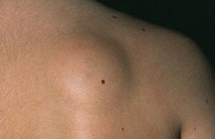 Липома на спине