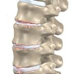 Остеохондроз