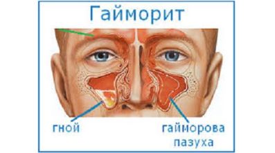 когда спина болит температура бывает