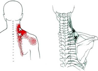 Что может болеть посередине спины ниже лопаток