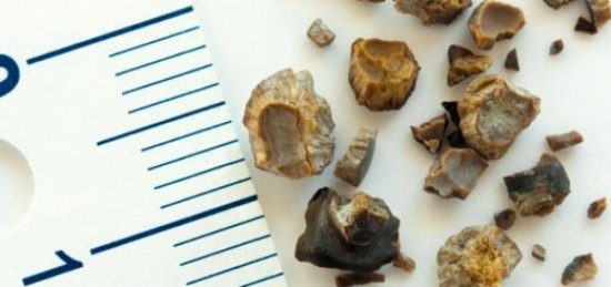 Конкременты