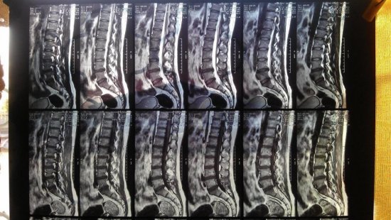 Рентген позвоночника