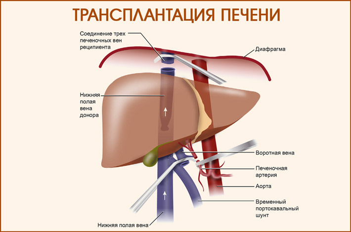 Трансплантация печени Пересадка печени