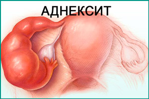 Воспаление яичников