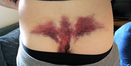 Гематома при переломе крестца