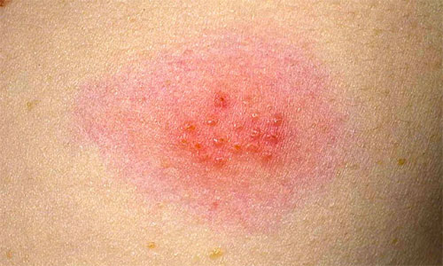 ВПГ на спине