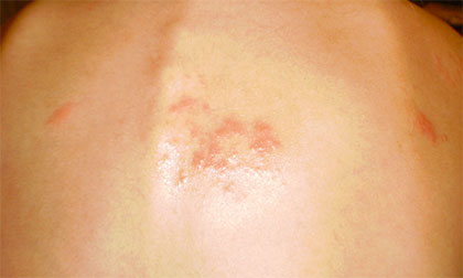 Опоясывающий лишай на спине