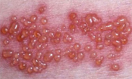 Герпетическая сыпь при опоясывающем лишае