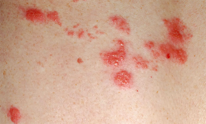 Герпесные везикулы при опоясывающем герпесе