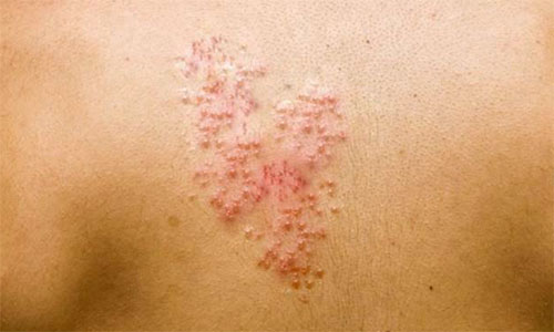 Высыпания Опоясывающего лишая на спине