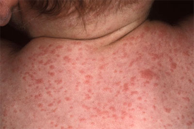 Сыпь детской Розеолы на спине и шее