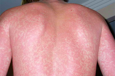 Высыпания при цитомегаловирусе