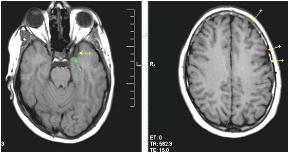 При резкой головной боли при вставании рекомендуют провести МРТ При резкой головной боли при вставании