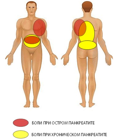 Локализация боли при панкреатите Локализация боли при панкреатите