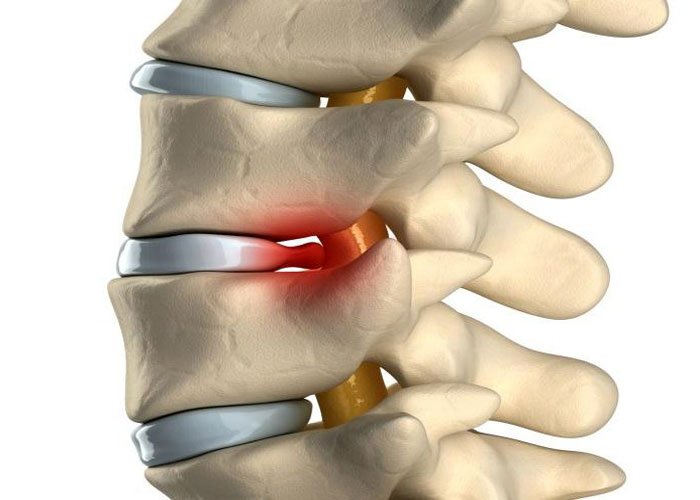 Межпозвоночная грыжа