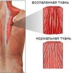 Мышечное воспаление