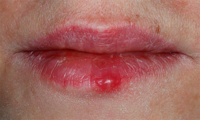 Вторая стадия герпеса на губах