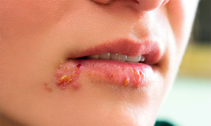 Третья стадия герпеса на губах