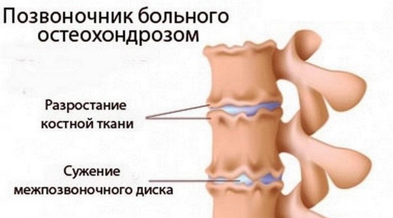 Болит спина в области лопаток к какому врачу обратиться