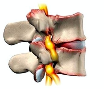 Сильно болит спина в области поясницы при ходьбе