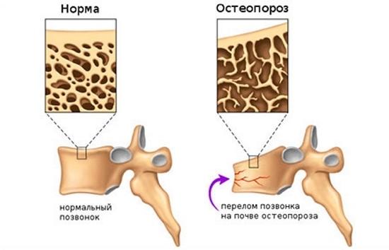 Перелом позвонка на фоне остеопороза Перелом позвонка на фоне остеопороза