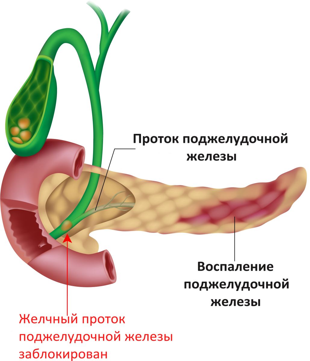 Схема панкреатита Схема панкреатита