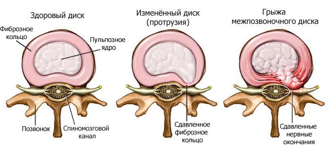Стадии развития межпозвоночной грыжи