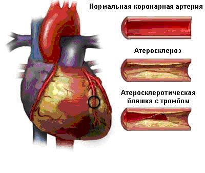 Боль от острого коронарного синдрома