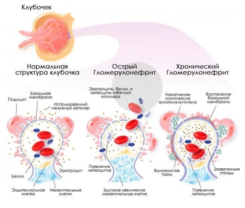 Хронический гломерулонефрит с мочевым синдромом лечение